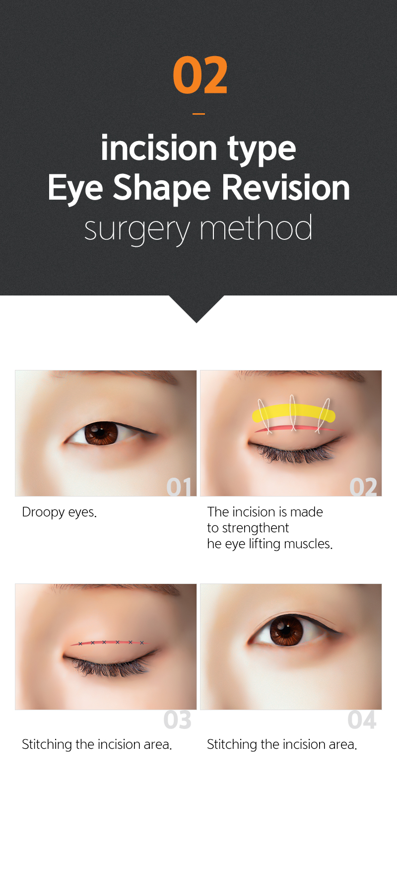 비절대 눈매교정 수술방법